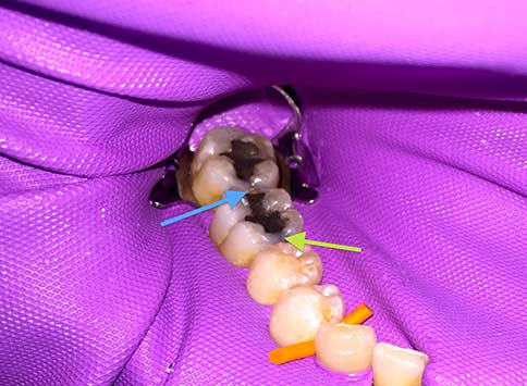 amalgam removal