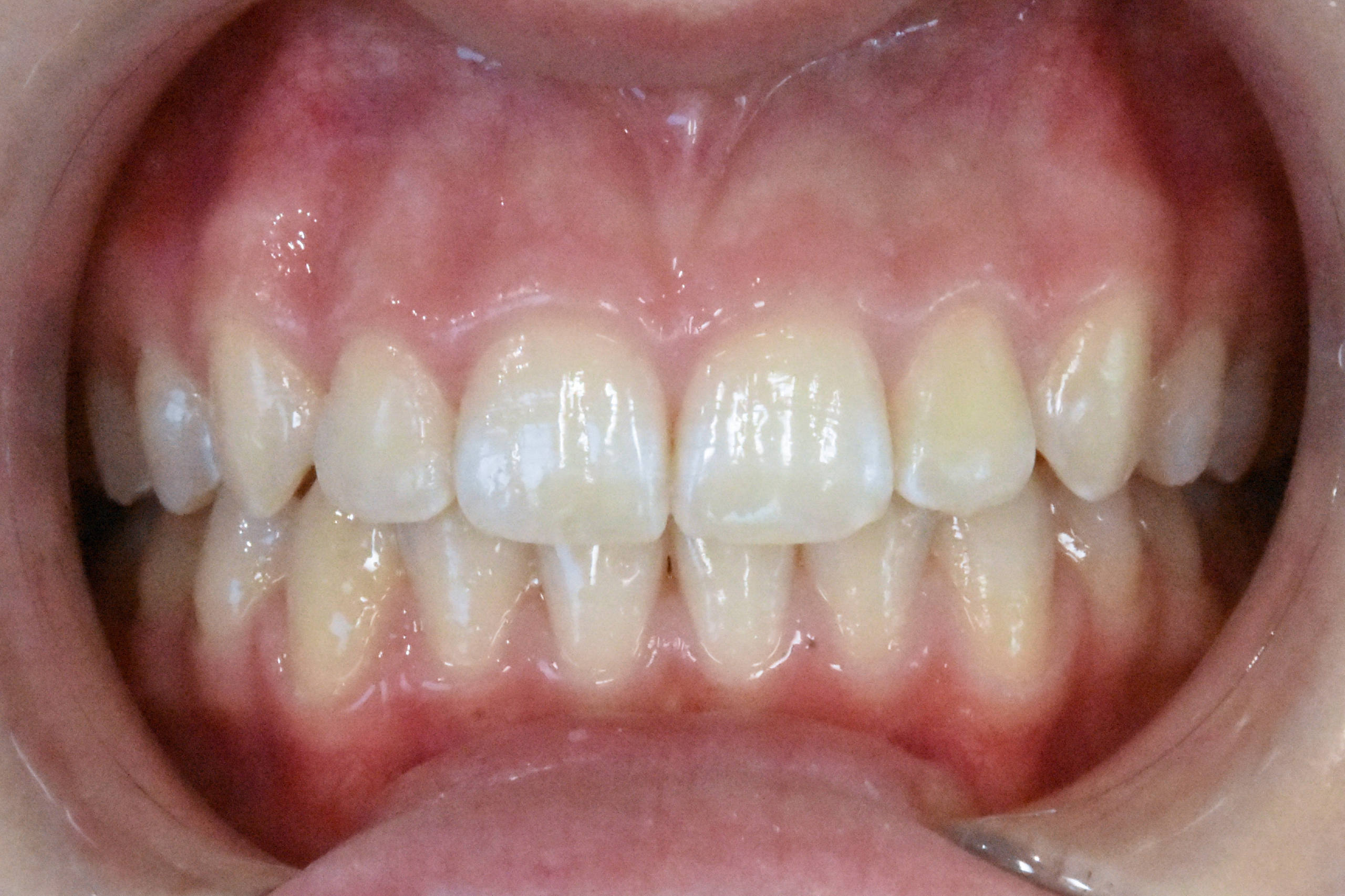 after 16 months of aligners
